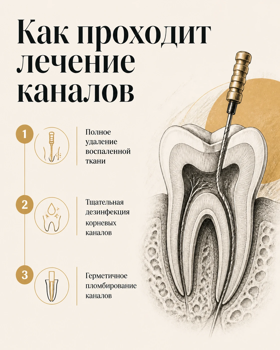 Слайд об этапах эндодонтического лечения